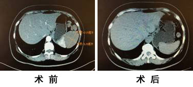 术前术后.jpg