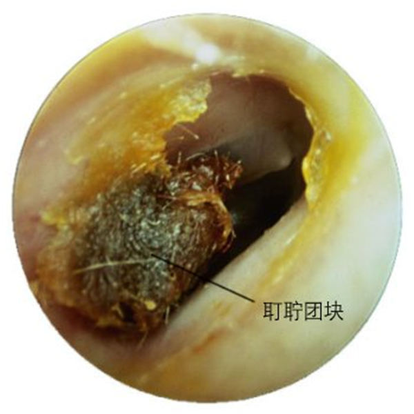 耵聍栓塞吸引器图片