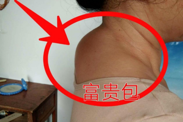 "富贵包"真的不是富贵,而是病!得治!