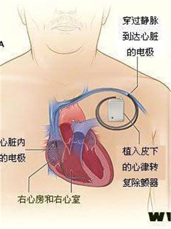 北京燕化医院成功完成首例埋藏式心脏复律除颤器植入