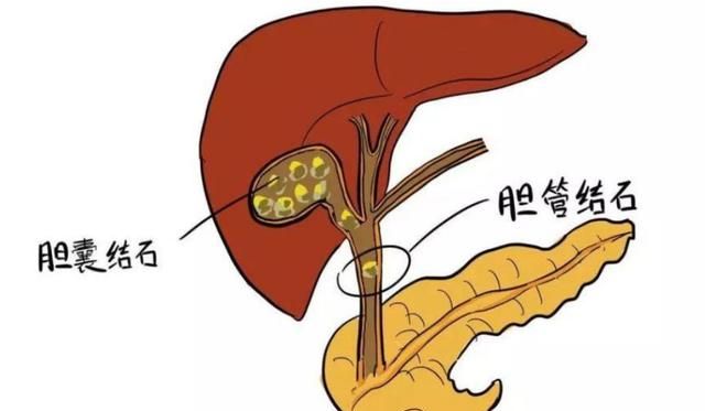 使胆囊运动迟缓,影响胆汁排泄,从而导致胆结石