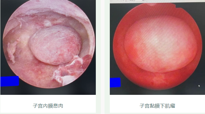 子宫里有疙瘩硬的图片图片